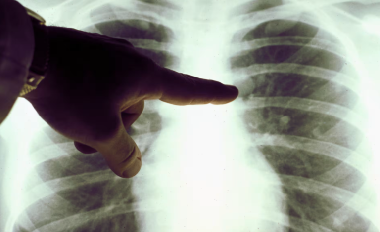Summit Therapeutics’ Lung-Cancer Drug Surpasses Merck’s Keytruda in Latest Trial, Shares Surge