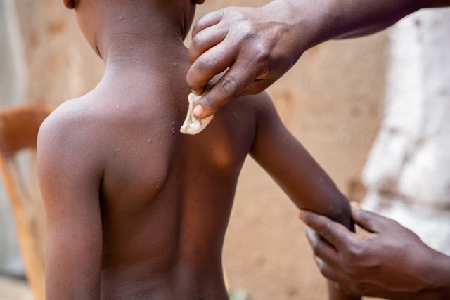 UNICEF Launches Emergency Tender for Mpox Vaccines for Crisis-Hit Countries