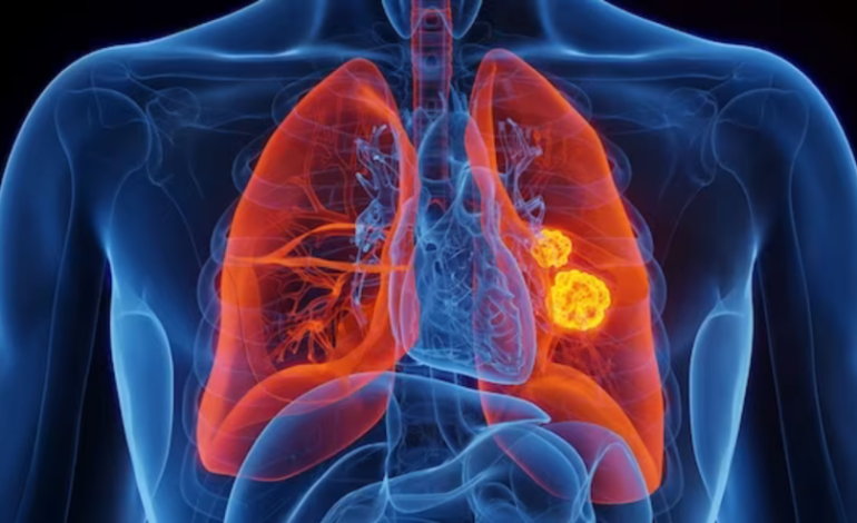 Lung Cancer Survival Rate Sees Significant Improvement, Study Finds