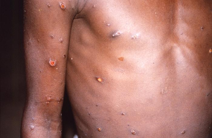 Measles Outbreak Claims Lives of Thousands of Children in Congo