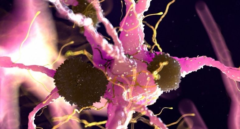 Parkinson’s Disease Breakthrough Suggests Potential FDA-Approved Treatment