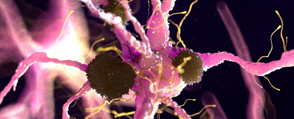 Parkinson’s Disease Breakthrough Suggests Potential FDA-Approved Treatment