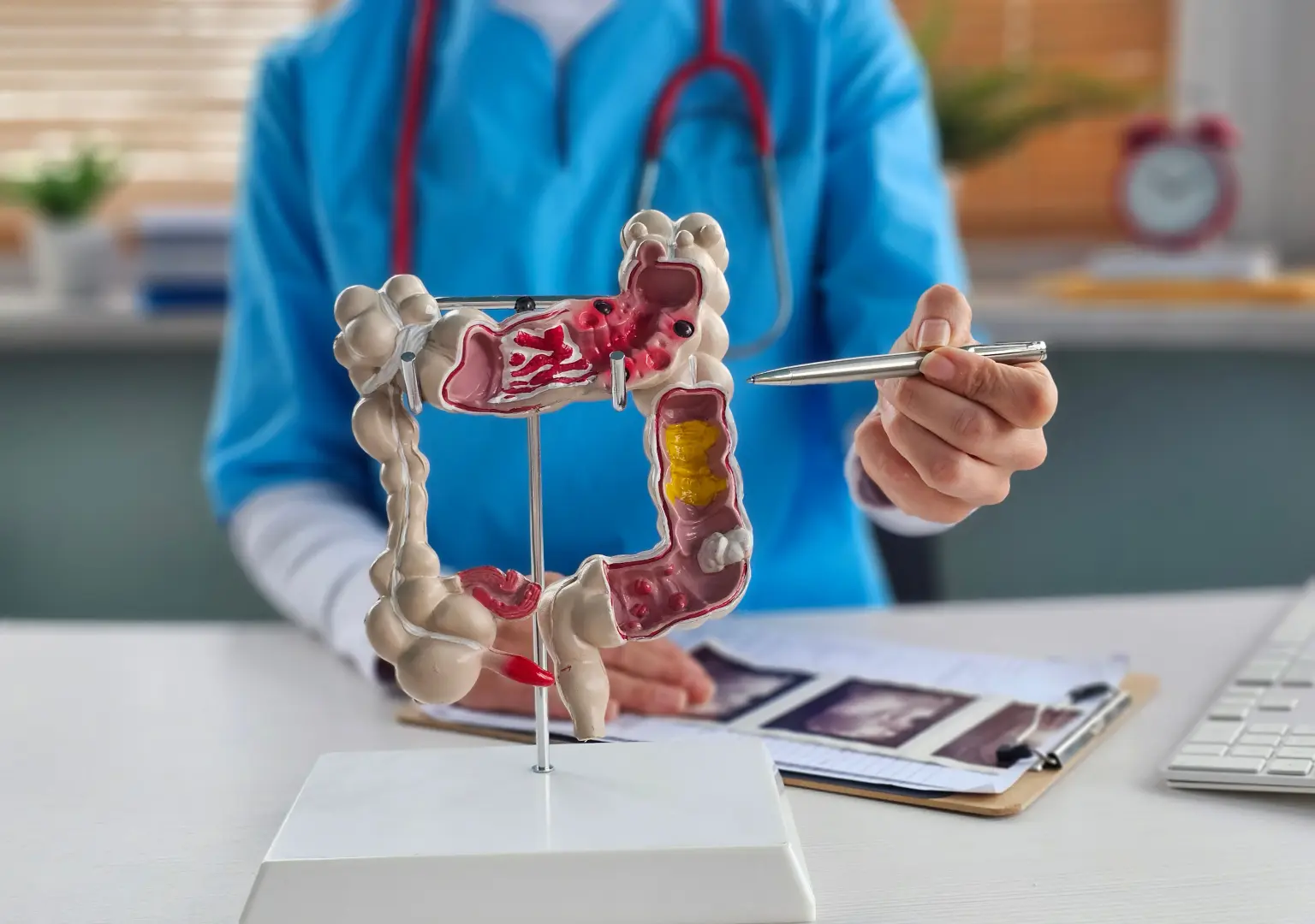Rising Cases of Colorectal Cancer in Young Adults: Why Early Screening Matters