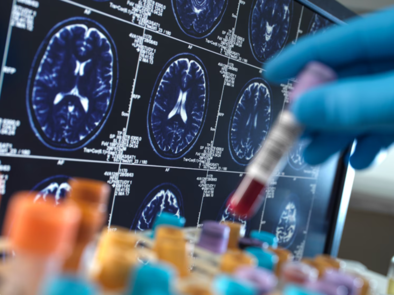 Alzheimer’s Association Urges Early Testing as New Tools Transform Diagnosis and Treatment