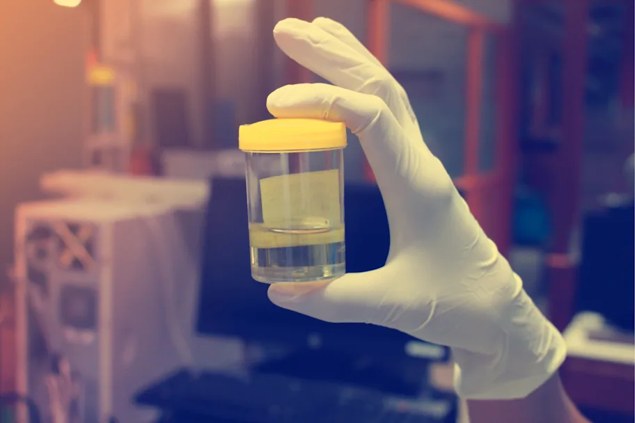 New Urine Test Shows Greater Accuracy in Detecting Prostate Cancer