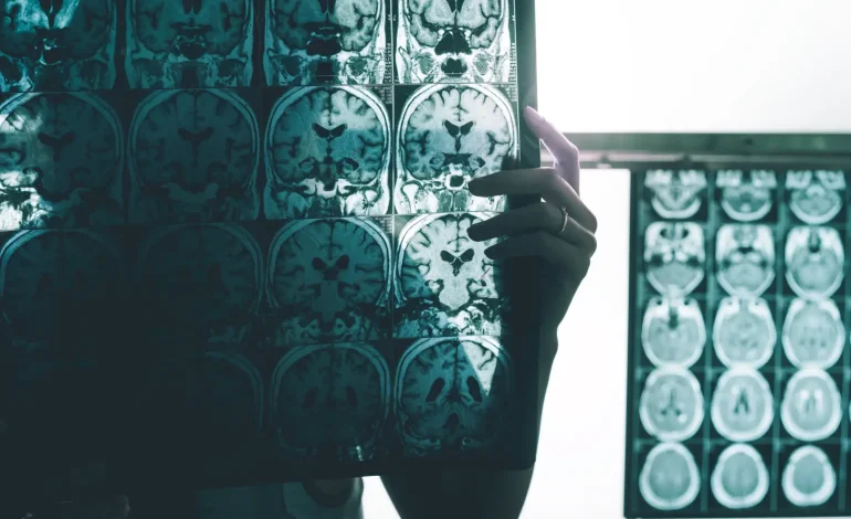 Existing HIV Drugs Show Promise in Reducing Alzheimer’s Risk, Study Finds
