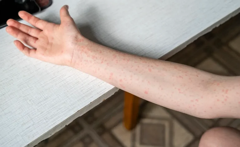 Canadian Traveler With Measles Sparks Health Alert in Washington State