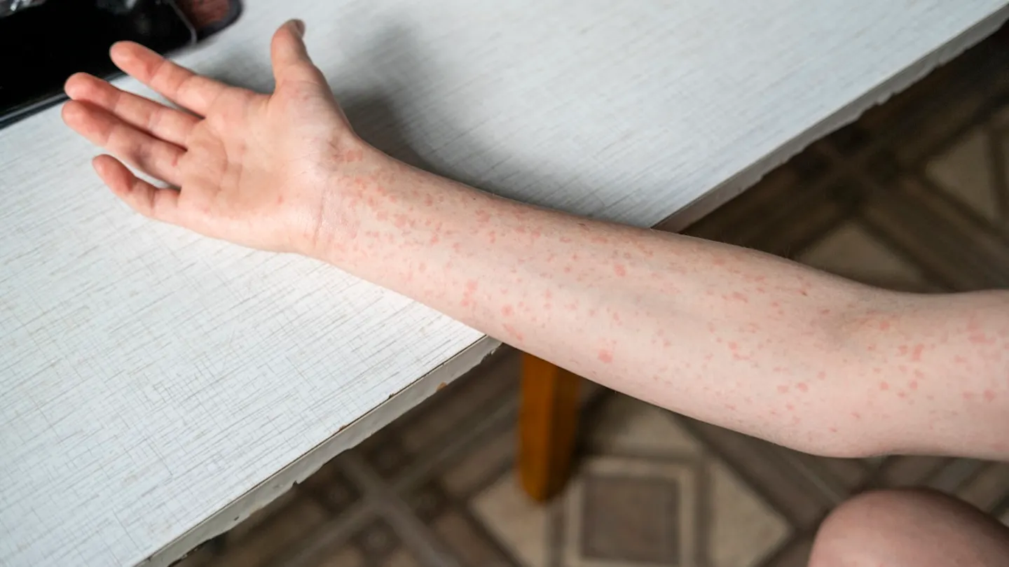 Canadian Traveler With Measles Sparks Health Alert in Washington State