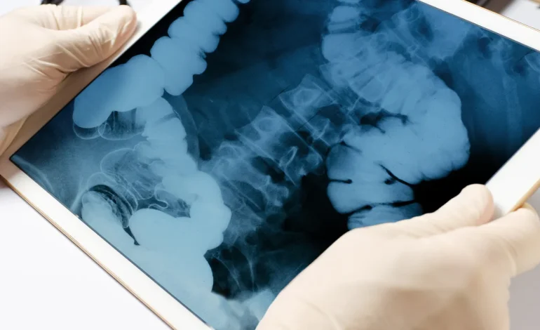 Rare Appendix Cancer Cases Surge Among Millennials, Gen X, Study Finds