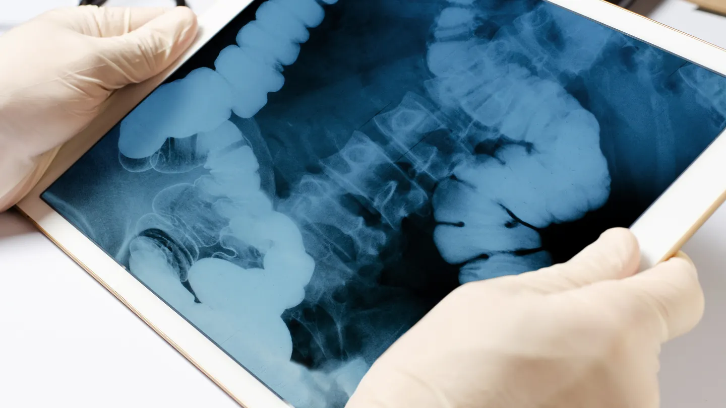 Rare Appendix Cancer Cases Surge Among Millennials, Gen X, Study Finds