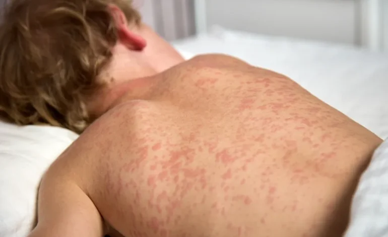 First Measles Case in Wyoming Since 2010 Confirmed in Casper