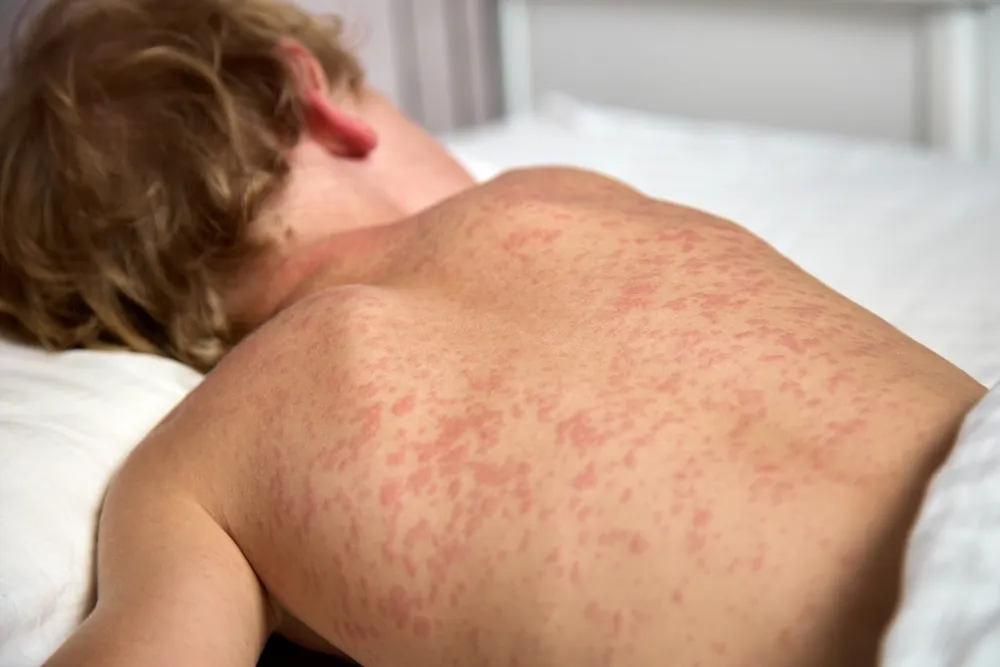 First Measles Case in Wyoming Since 2010 Confirmed in Casper