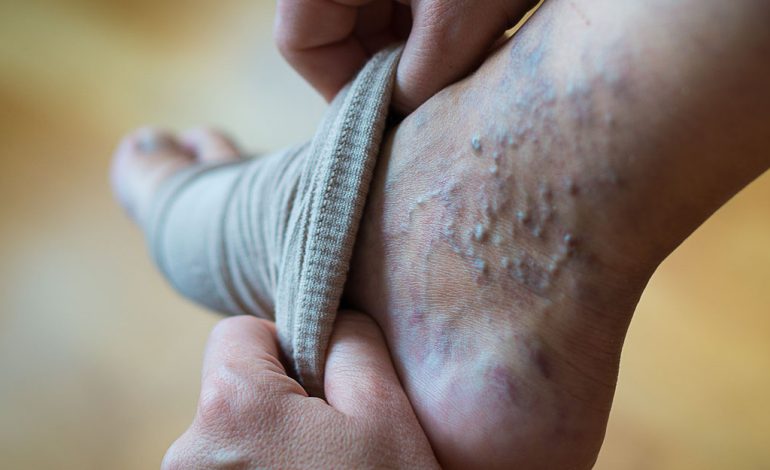 Swollen Ankles, Blood Clots, and What They Could Be Telling You About Your Veins