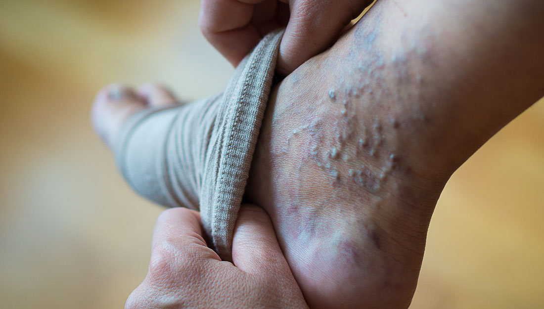Swollen Ankles, Blood Clots, and What They Could Be Telling You About Your Veins