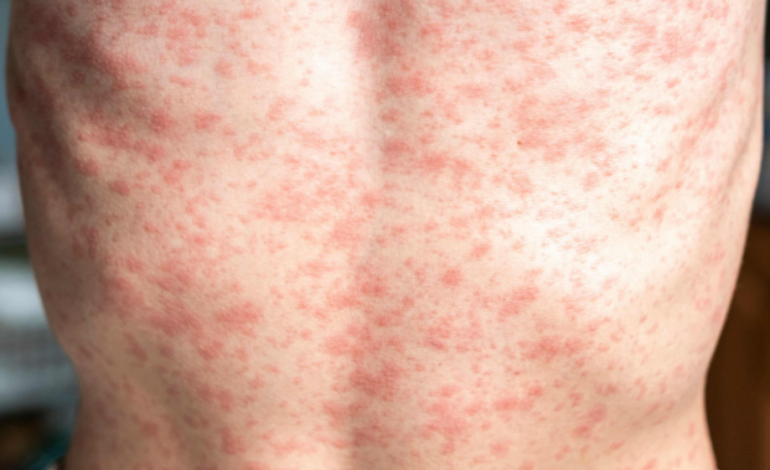 CCH Urges Locals to Stay Sharp as Measles Cases Climb Across Wyoming