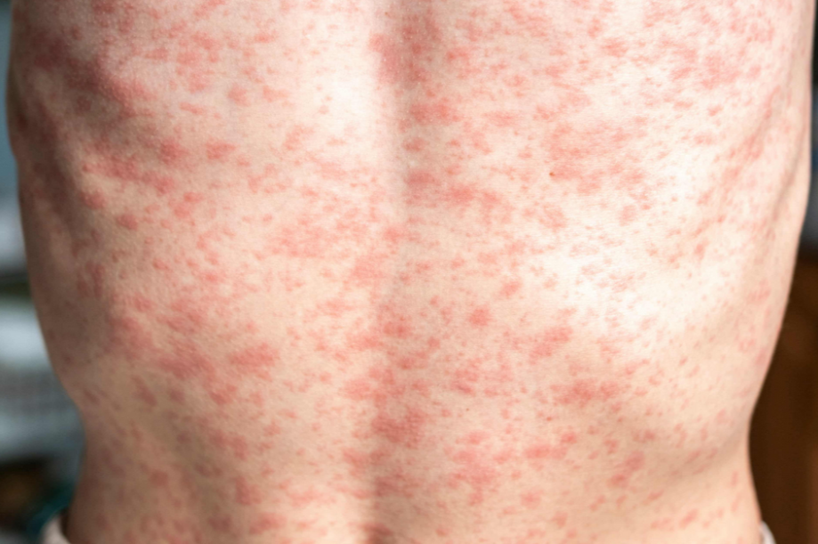 CCH Urges Locals to Stay Sharp as Measles Cases Climb Across Wyoming